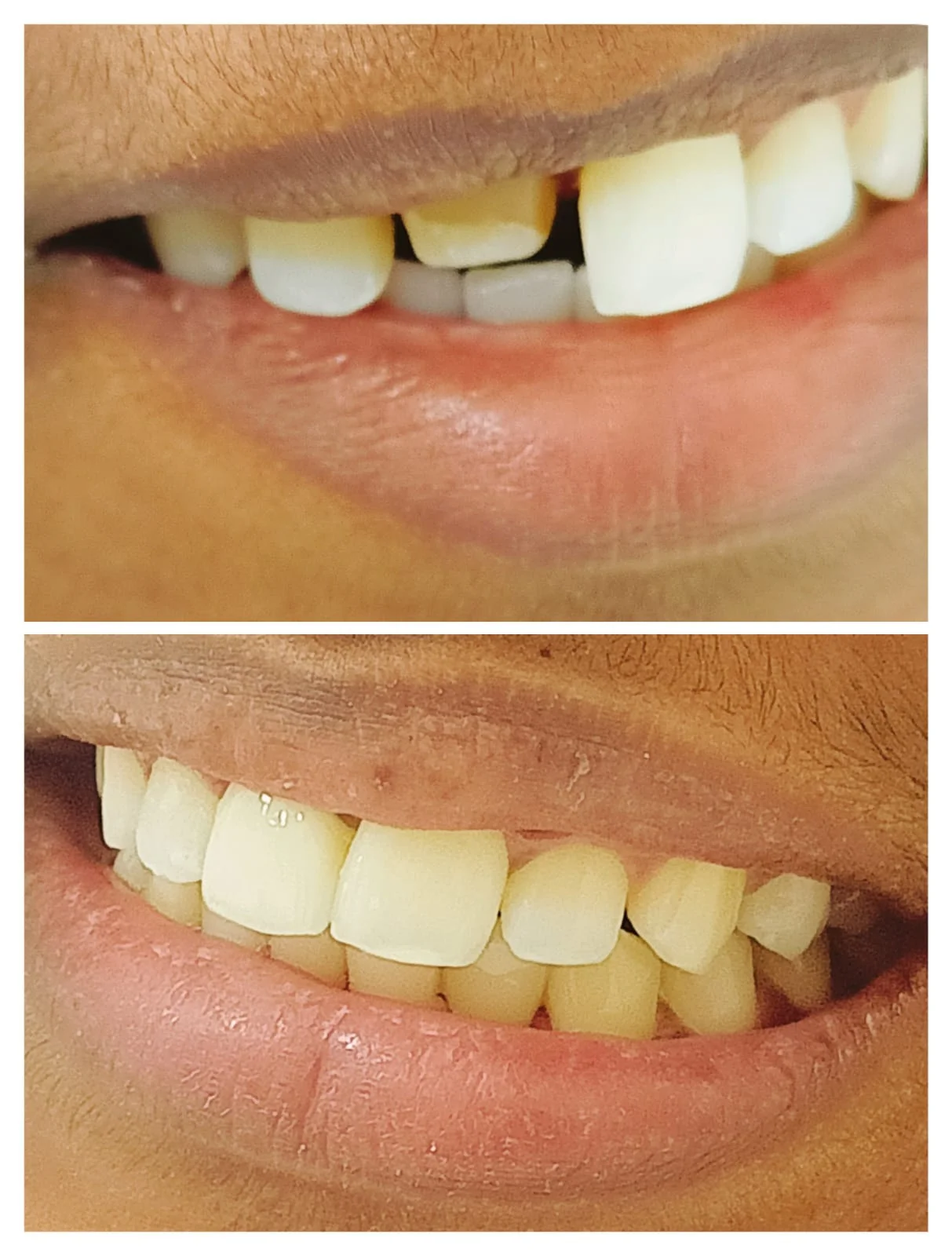 Anterior Smile Correction #1